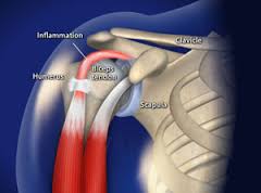 التهاب تاندون عضله دو سر,  biceps tendinitis